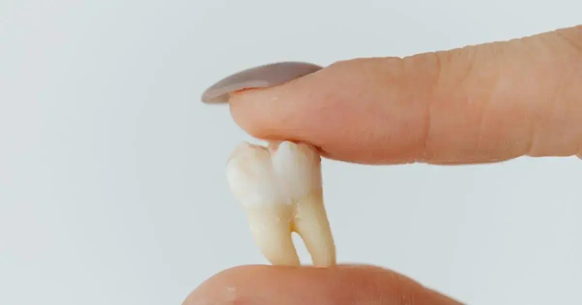 Quando os dentes do siso costumam nascer? Quando os dentes do siso costumam nascer?